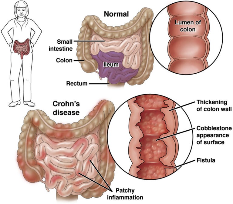 Crohn's Disease IBD Symptoms Advances Impact Causes